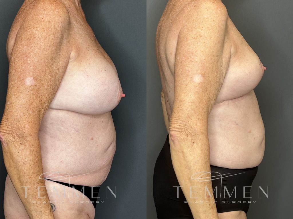 Implant Removal And Lift Before & After