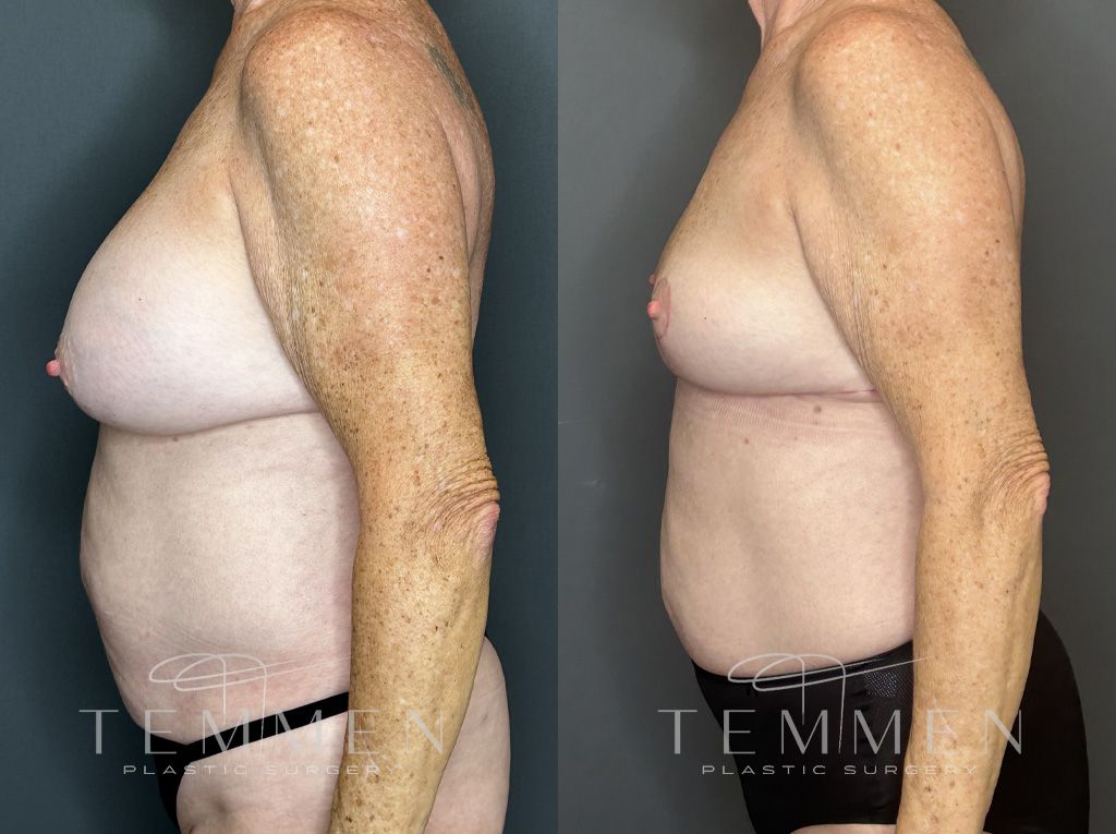 Implant Removal And Lift Before & After