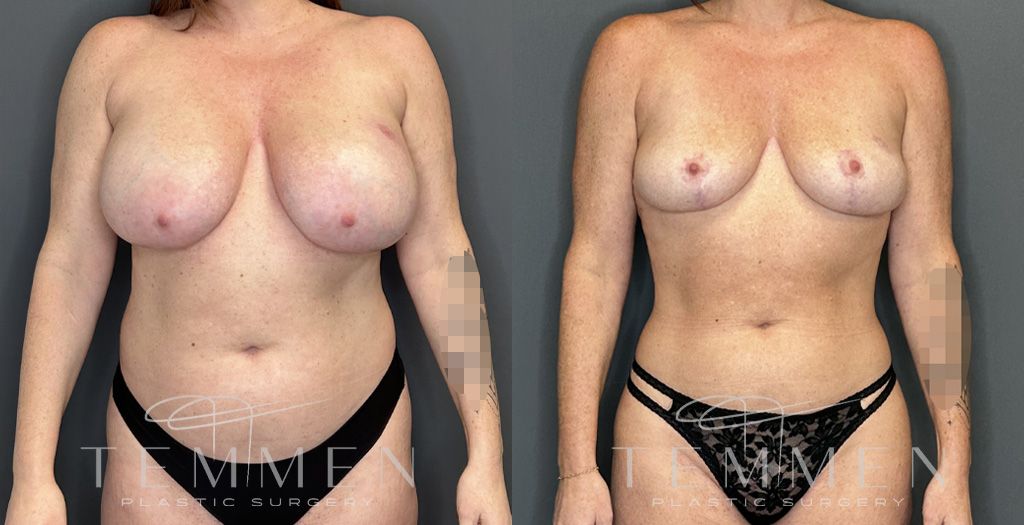 Implant Removal And Lift Before & After