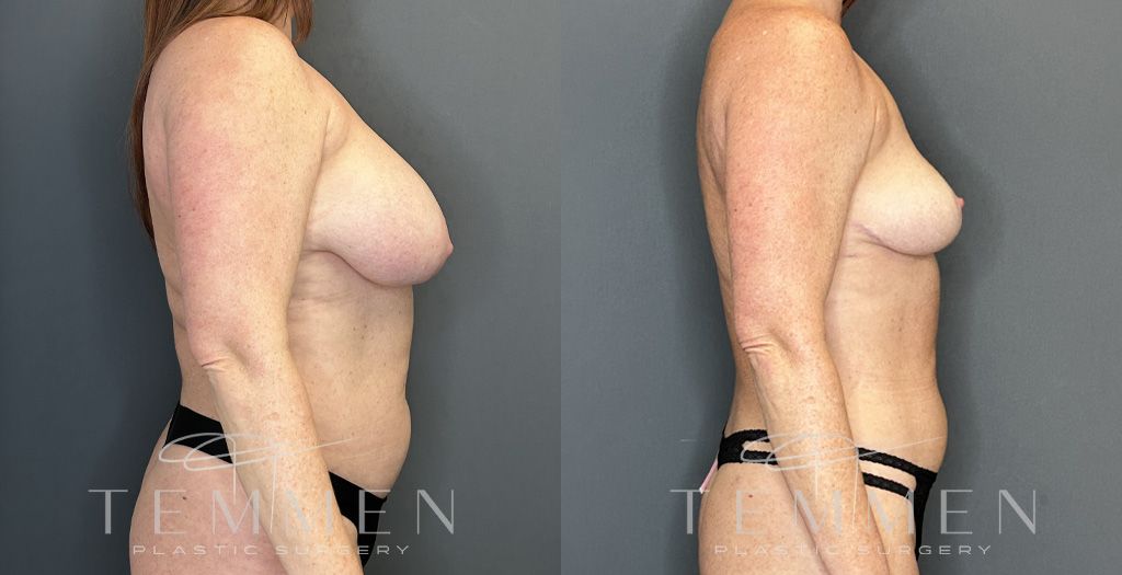 Implant Removal And Lift Before & After