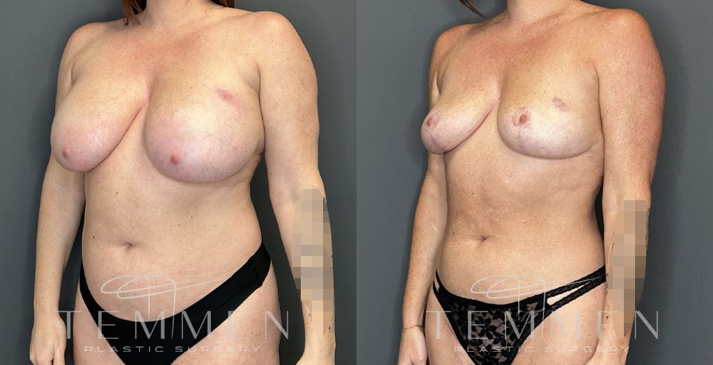 Implant Removal And Lift Before & After