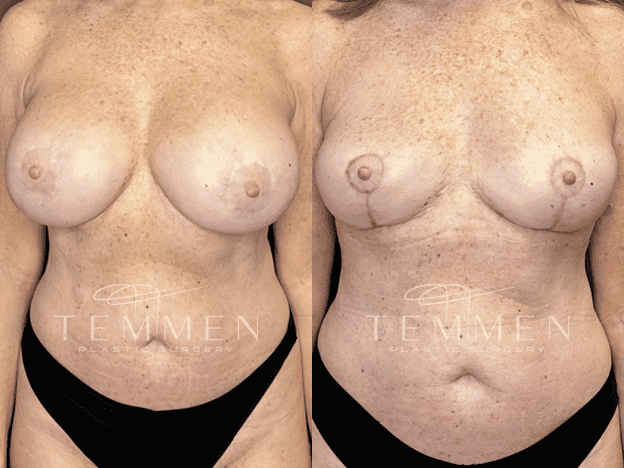 Implant Removal And Lift Before & After