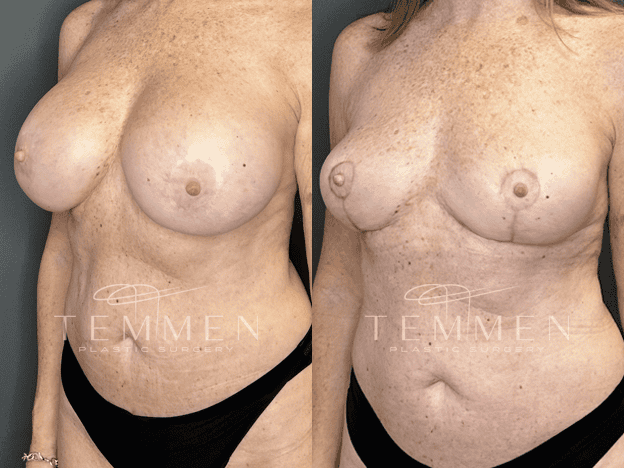 Implant Removal And Lift Before & After
