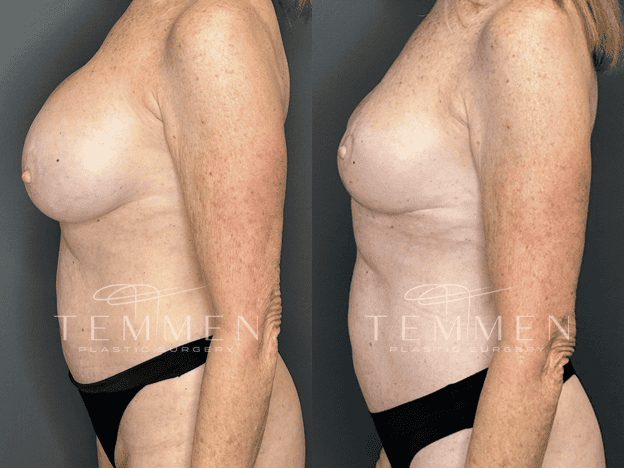 Implant Removal And Lift Before & After