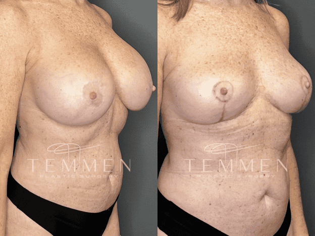 Implant Removal And Lift Before & After