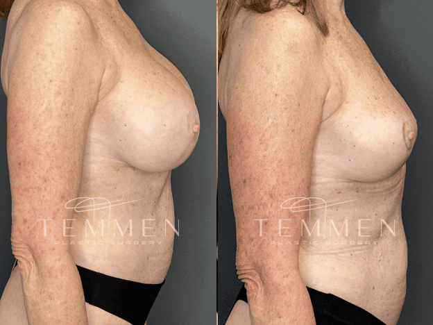 Implant Removal And Lift Before & After