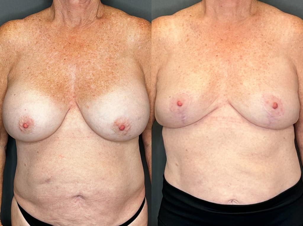 Implant Removal And Lift Before & After