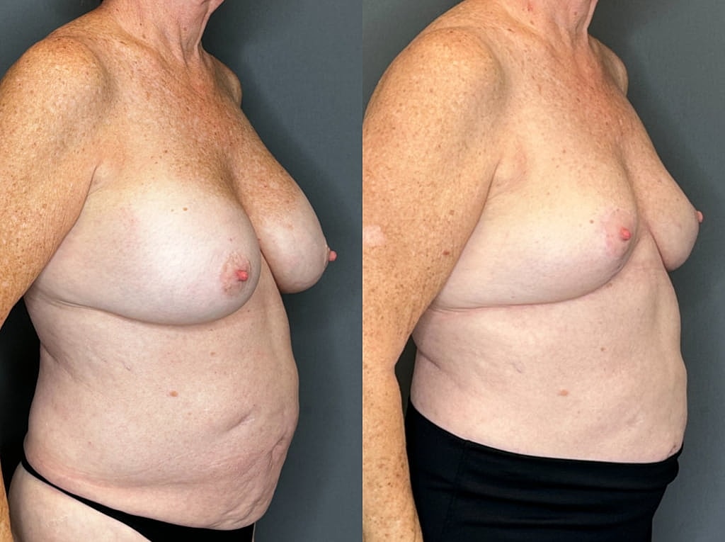 Implant Removal And Lift Before & After