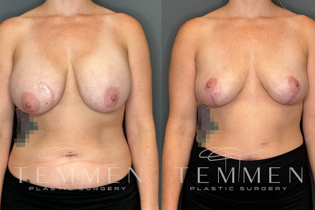 Implant Removal And Lift Before & After