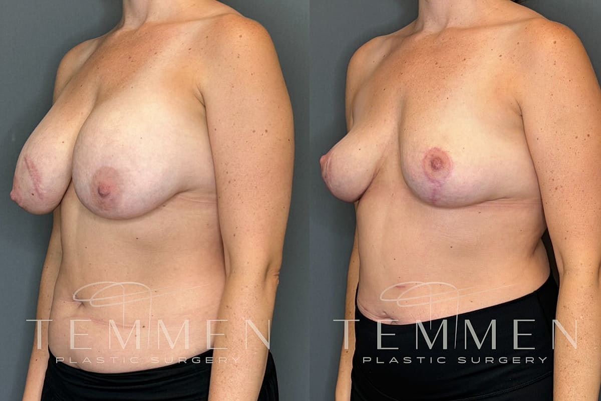 Implant Removal And Lift Before & After