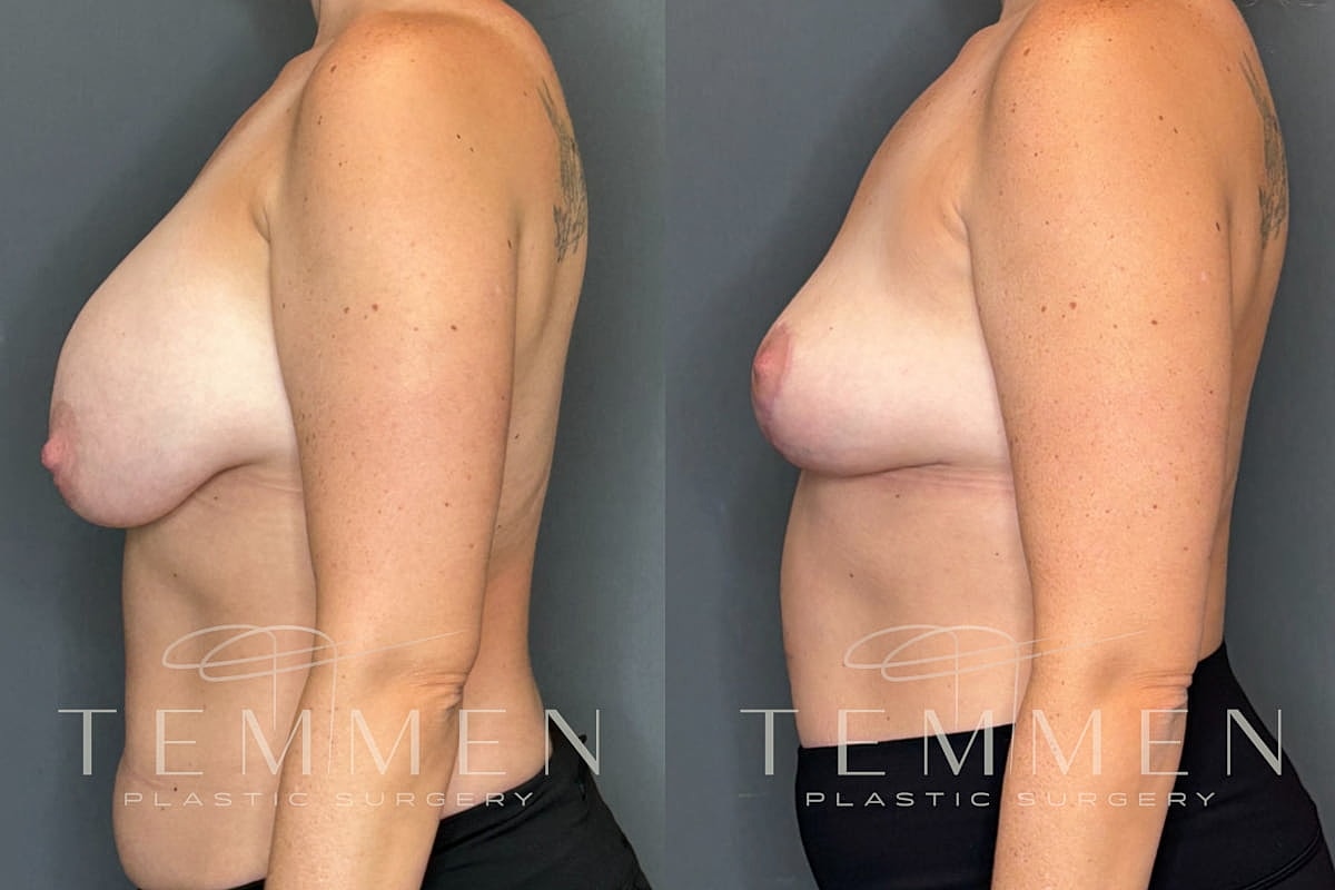 Implant Removal And Lift Before & After