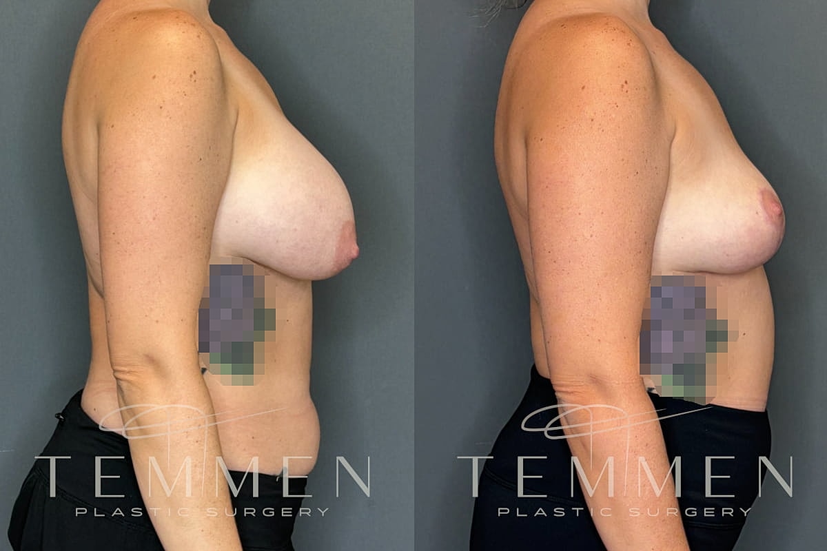 Implant Removal And Lift Before & After