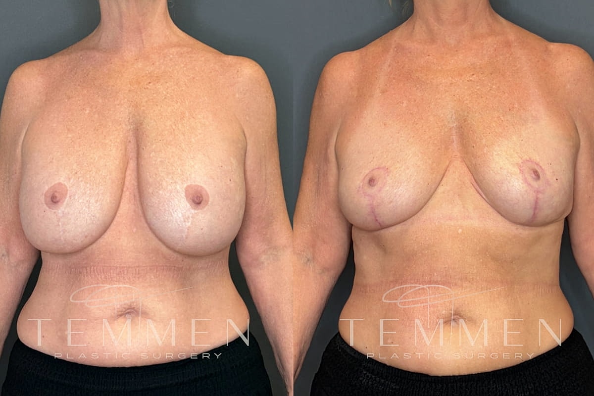 Implant Removal And Lift Before & After