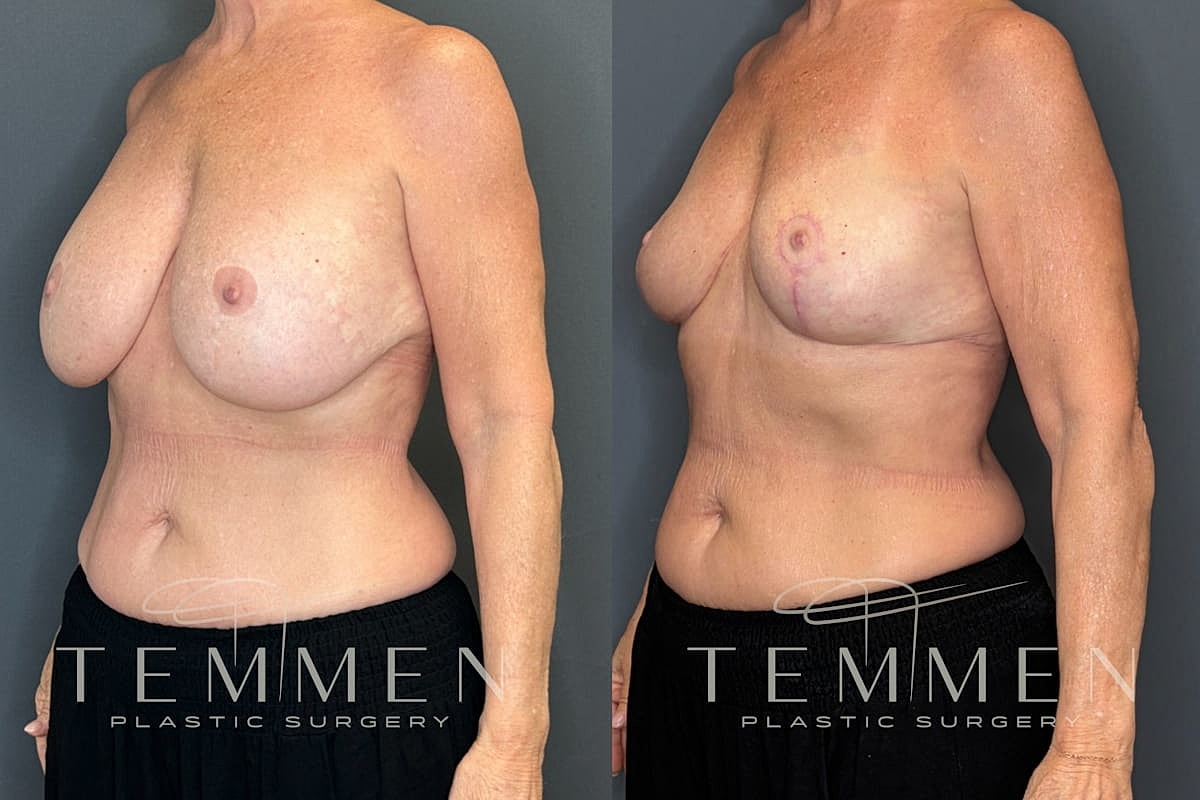 Implant Removal And Lift Before & After