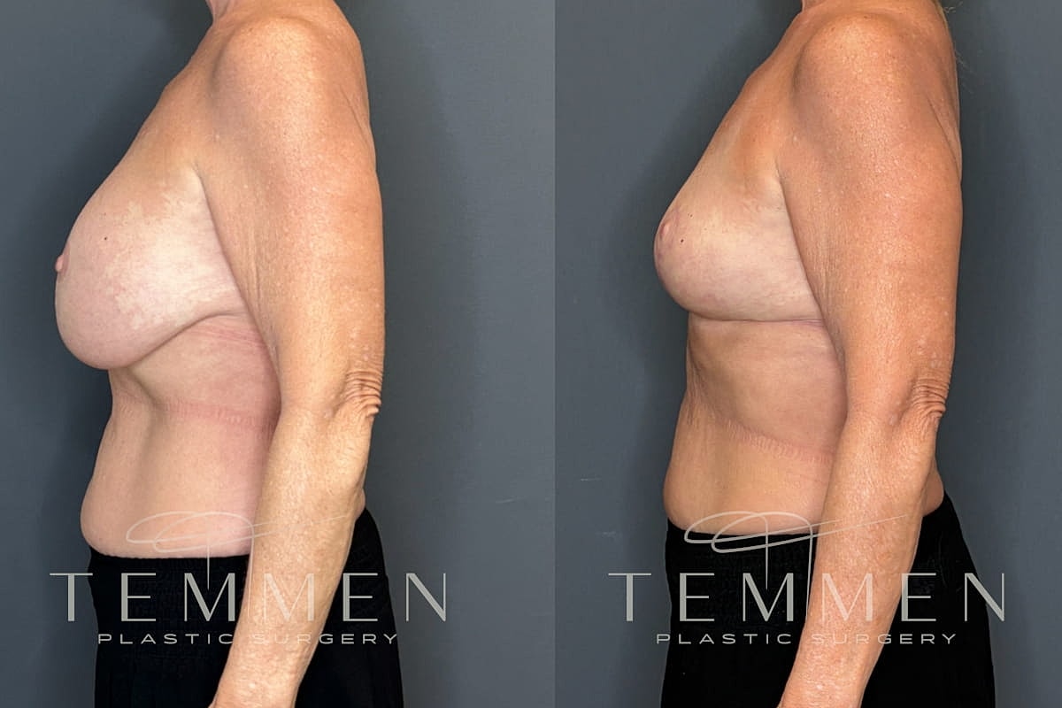 Implant Removal And Lift Before & After