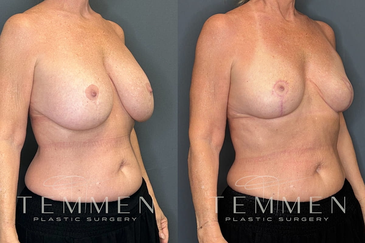 Implant Removal And Lift Before & After