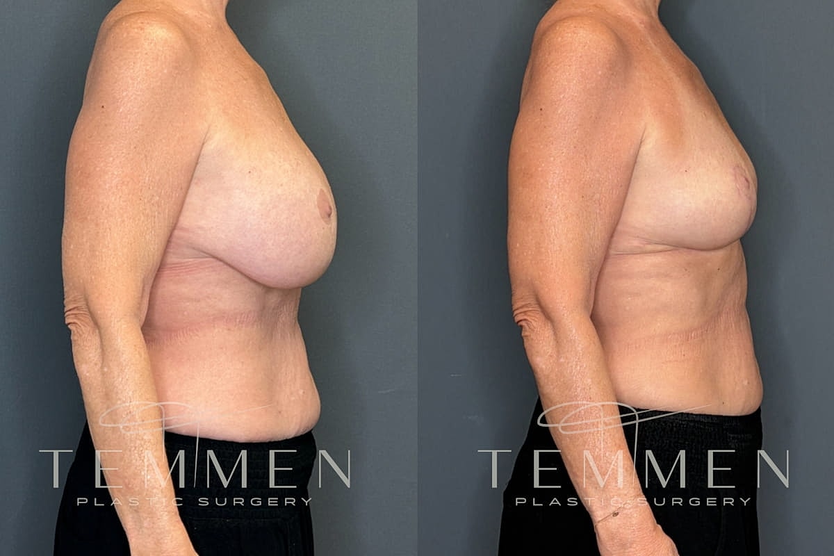 Implant Removal And Lift Before & After