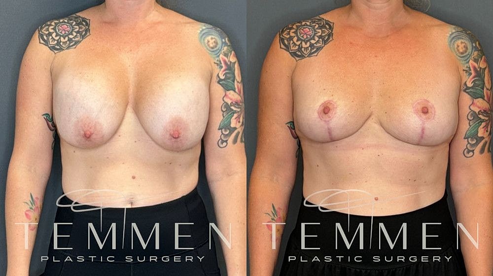 Implant Removal And Lift Before & After