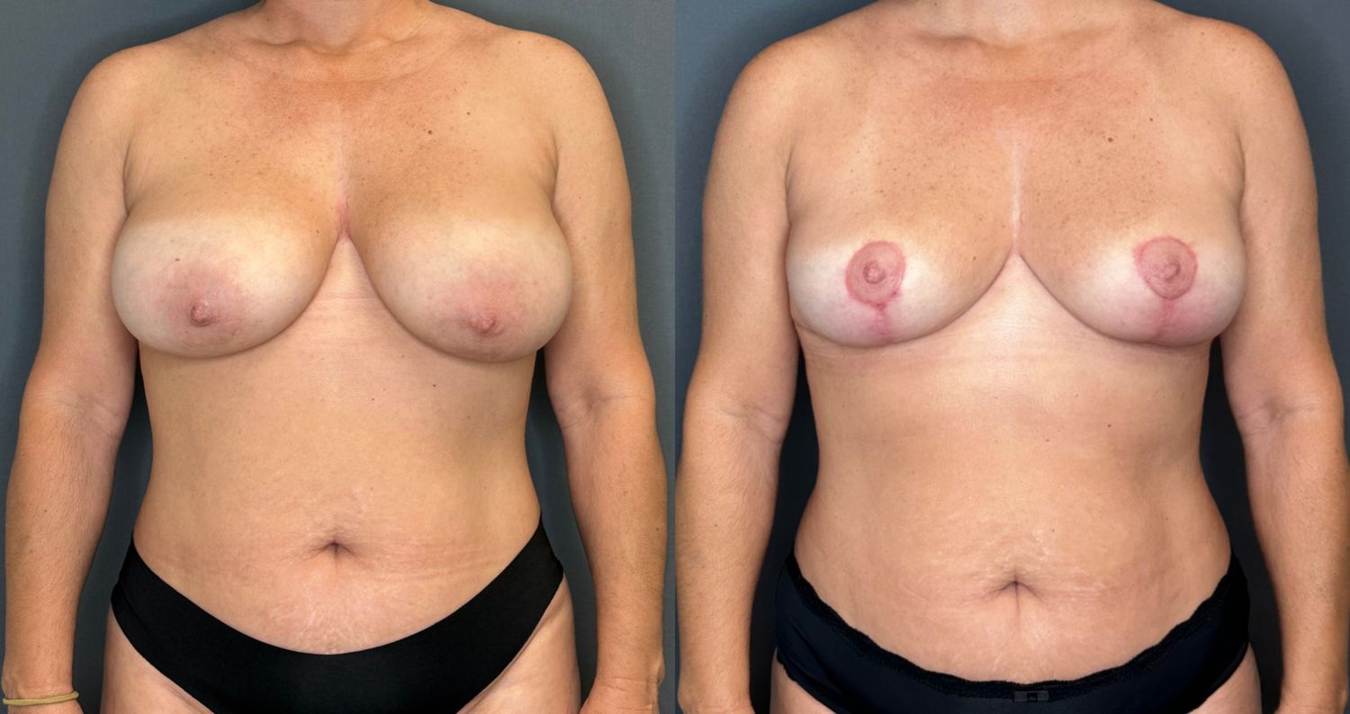 Implant Removal And Lift Before & After