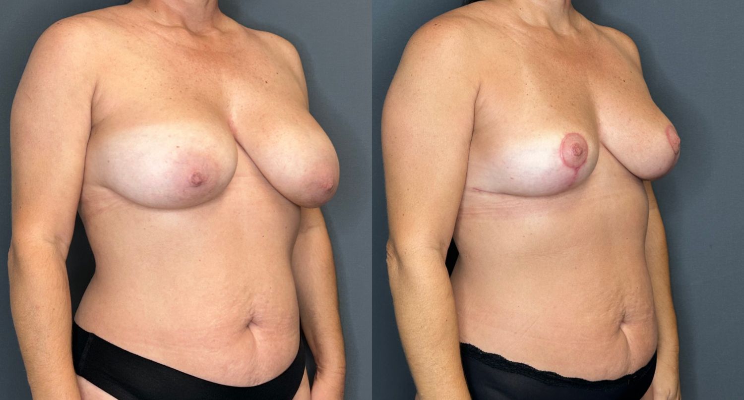 Implant Removal And Lift Before & After