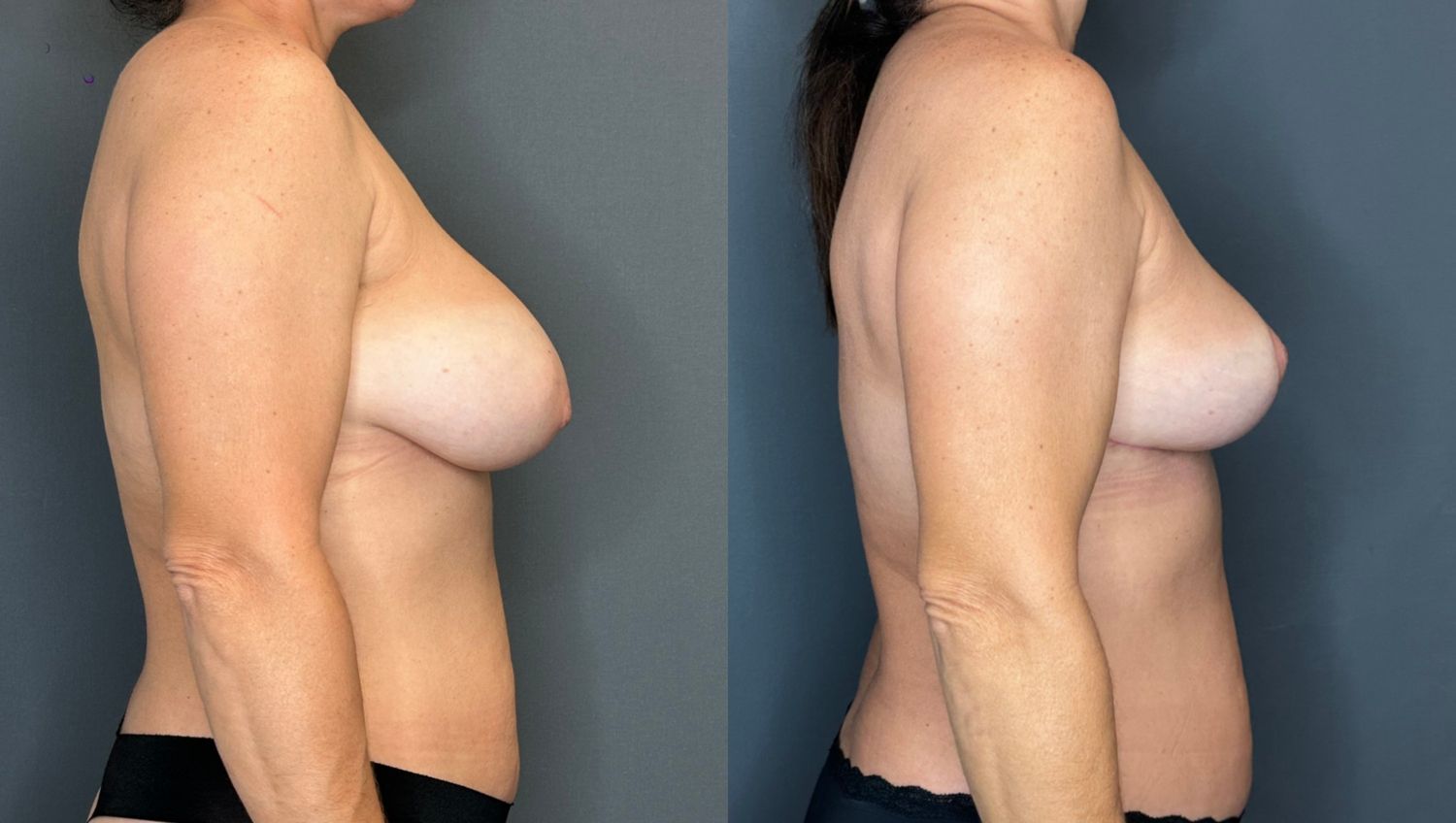 Implant Removal And Lift Before & After