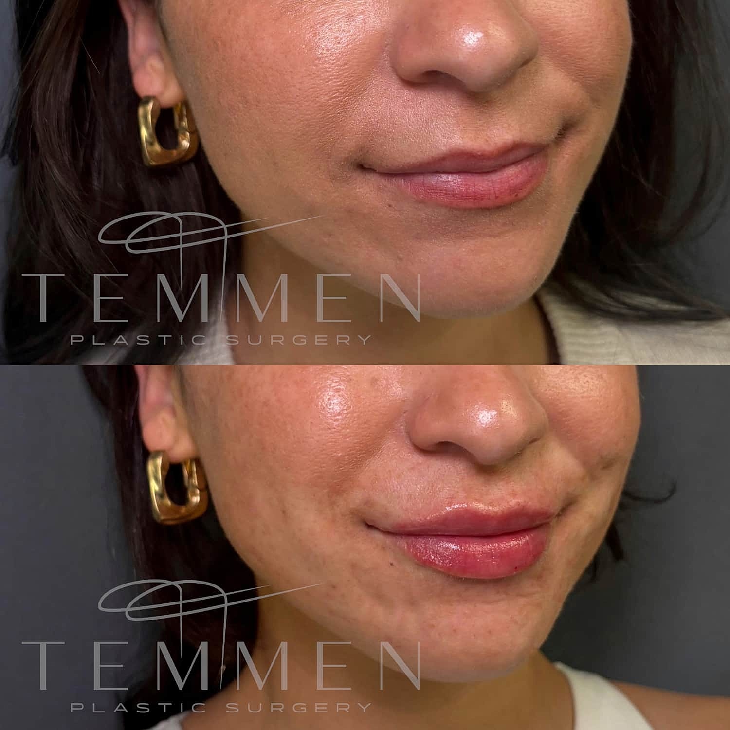 Lip Filler Before & After