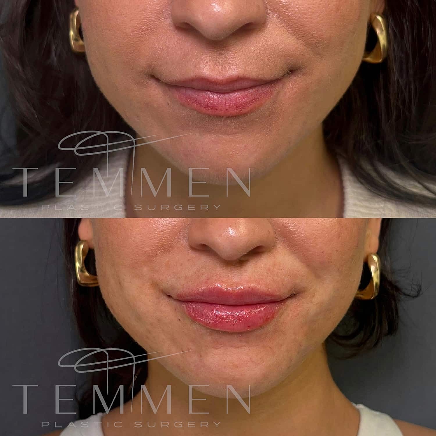 Lip Filler Before & After