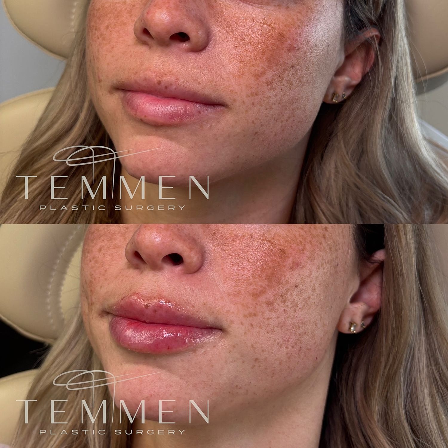 Lip Filler Before & After