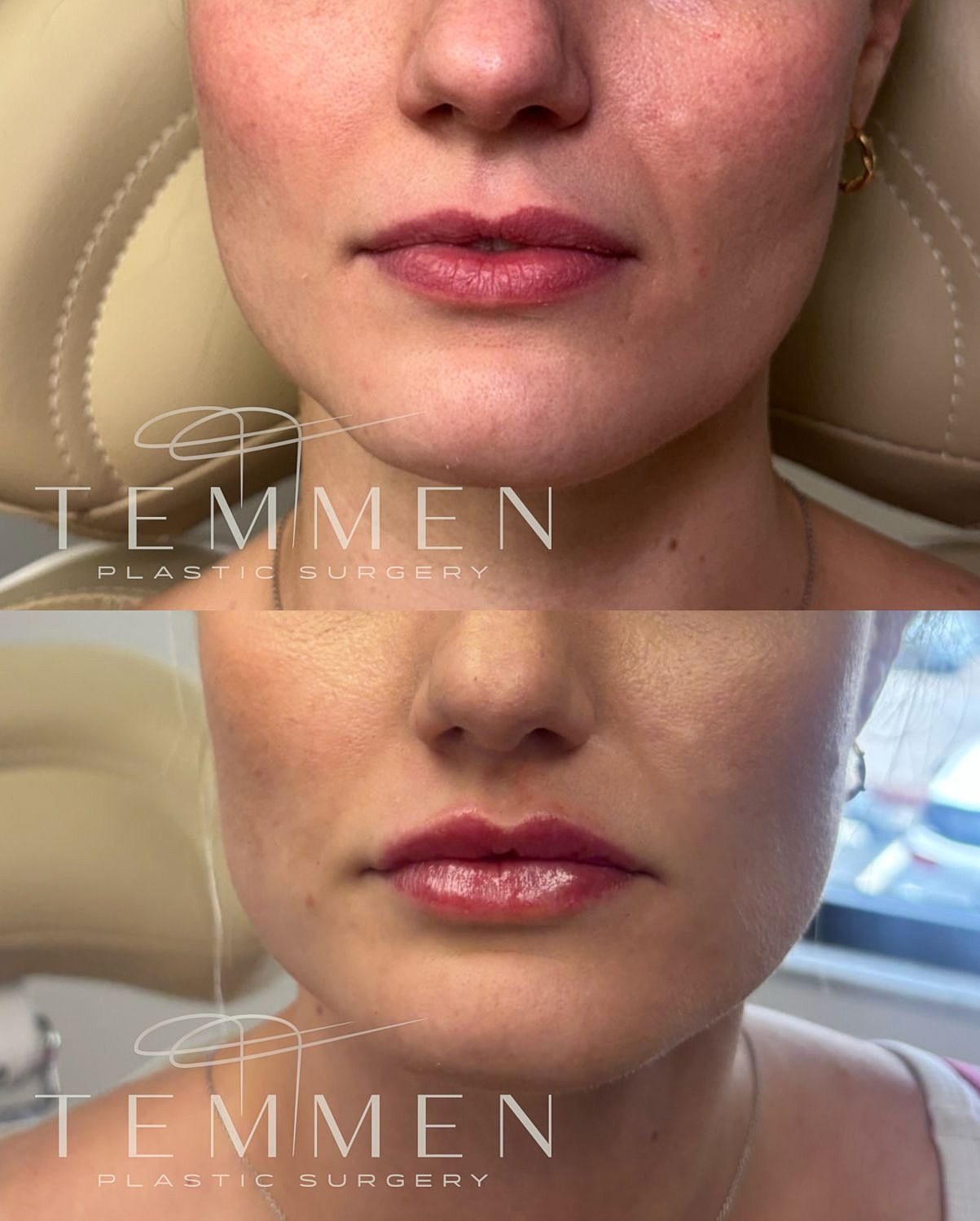 Lip Filler Before & After