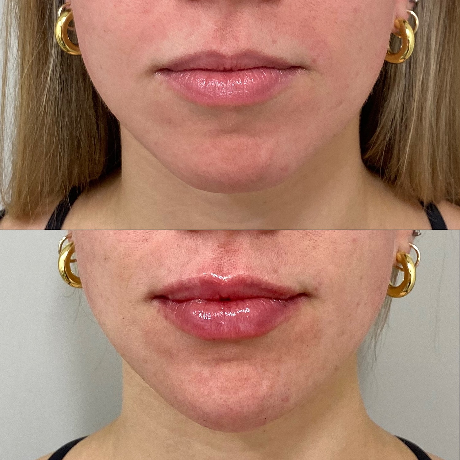 Lip Filler Before & After