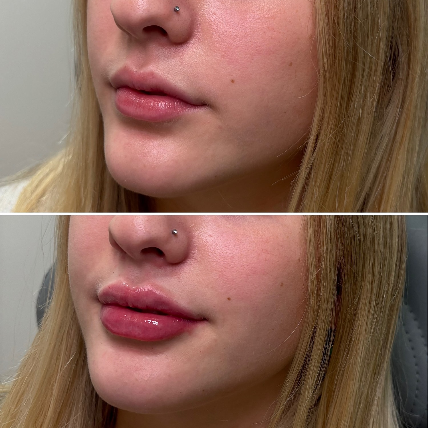 Lip Filler Before & After