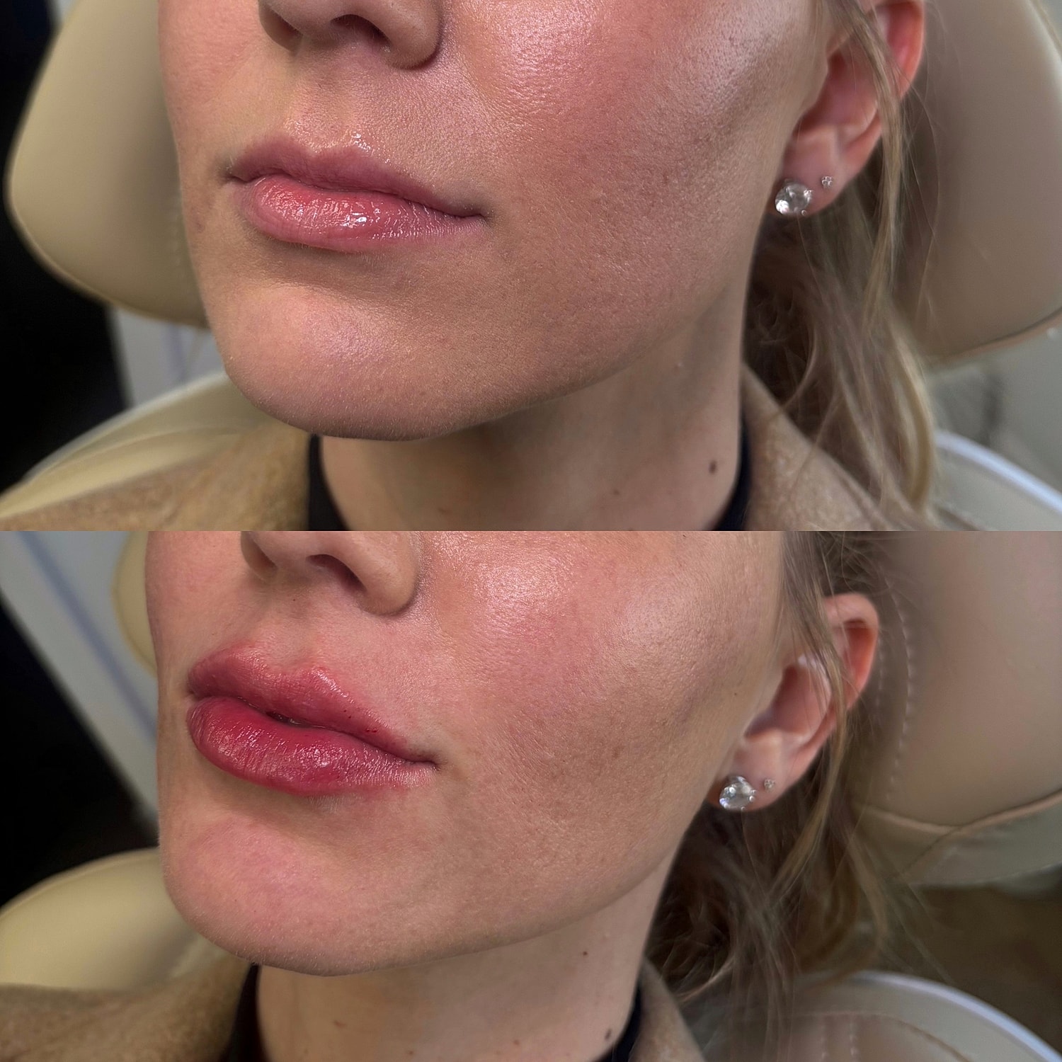 Lip Filler Before & After