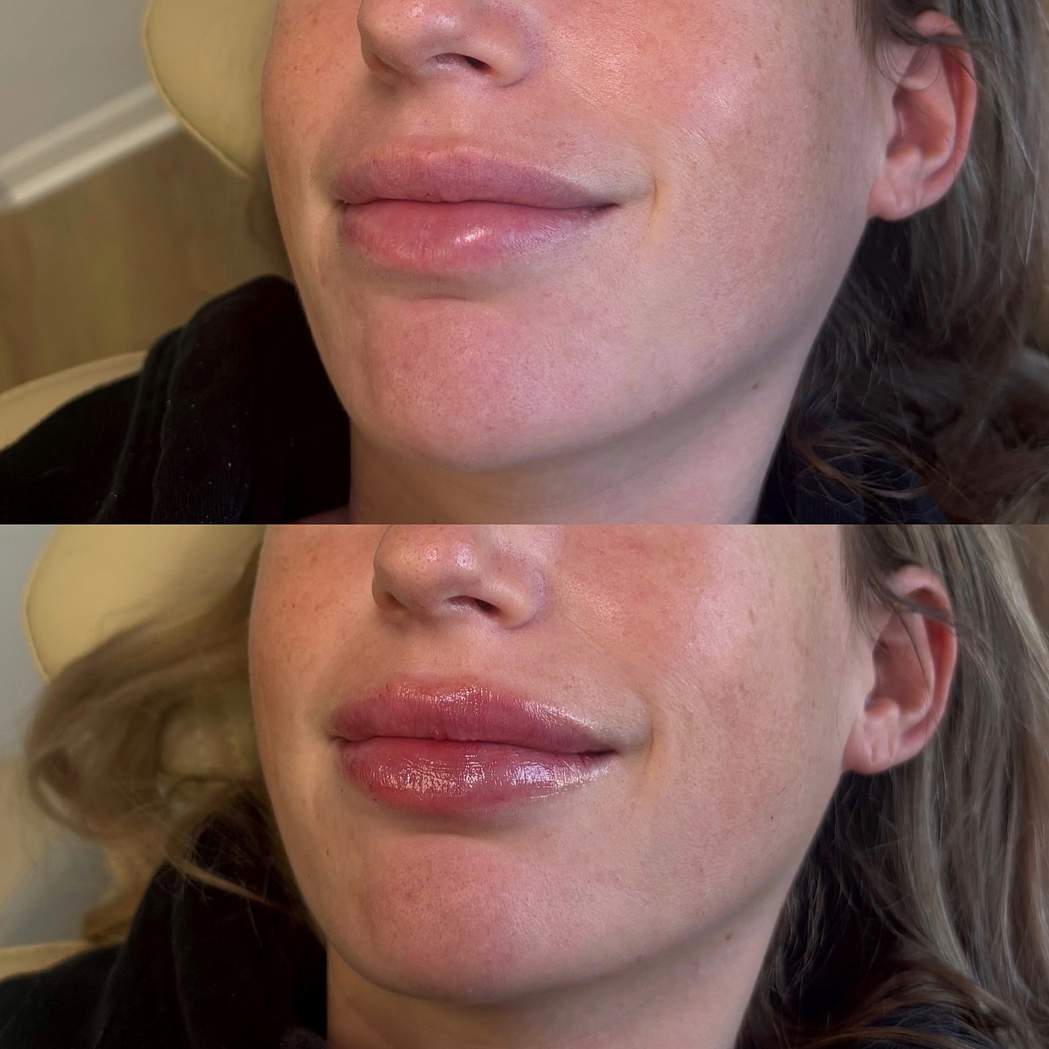 Lip Filler Before & After
