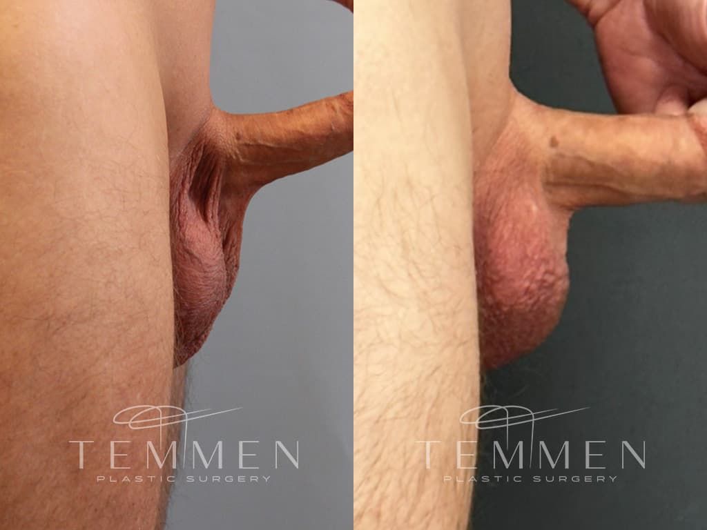 Scrotal Reduction Before & After