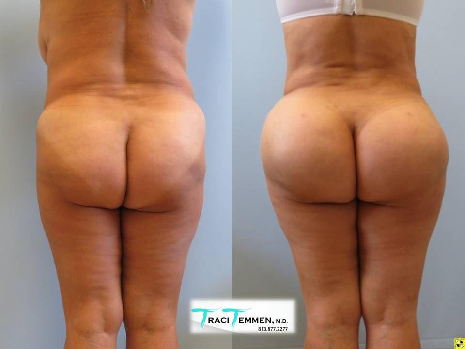 Brazilian Mommy Makeover Before & After