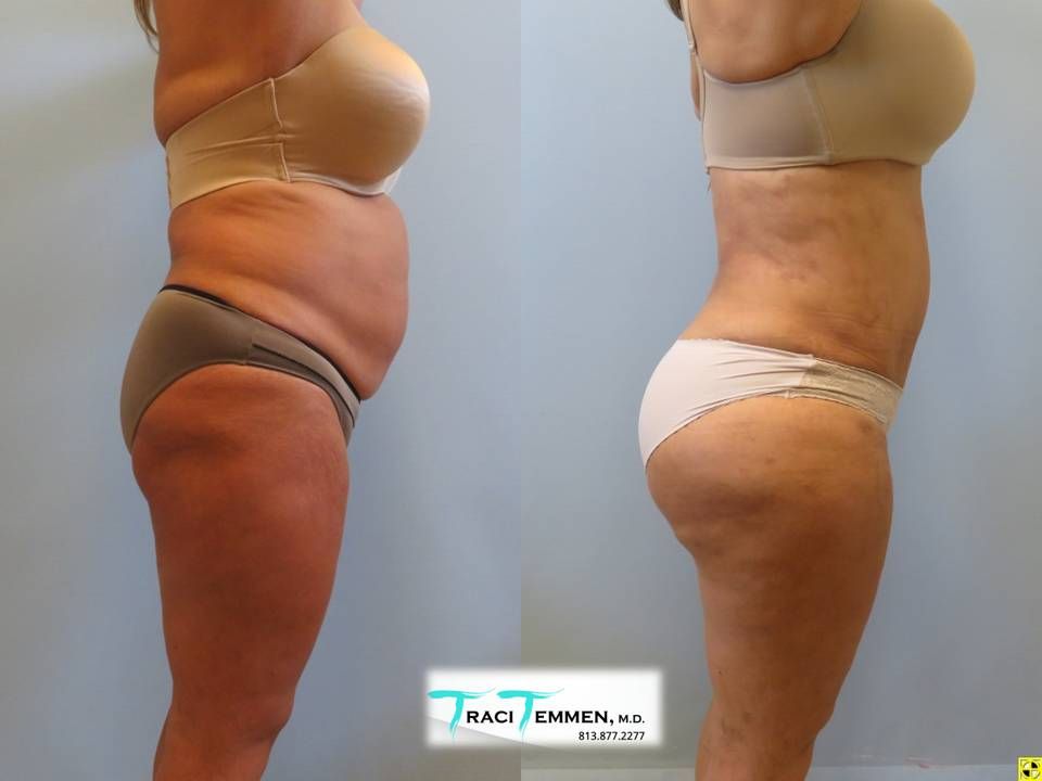 Brazilian Mommy Makeover Before & After