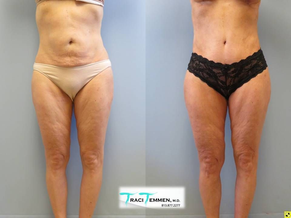 Brazilian Mommy Makeover Before & After