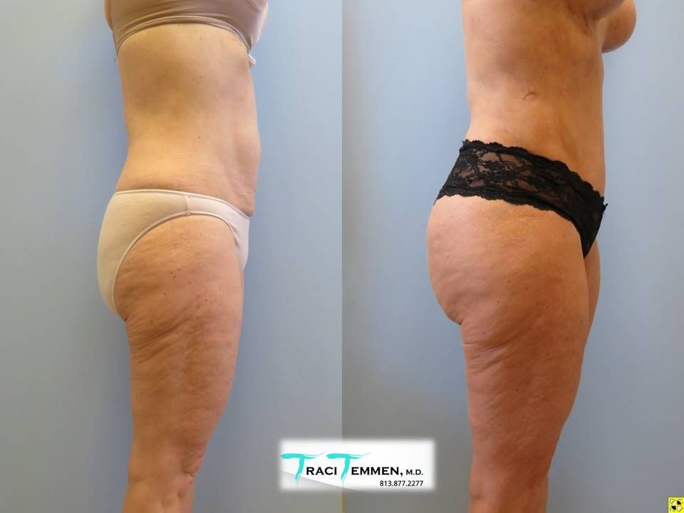 Brazilian Mommy Makeover Before & After