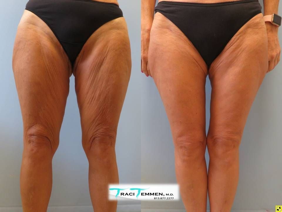 Thigh Lift Before & After