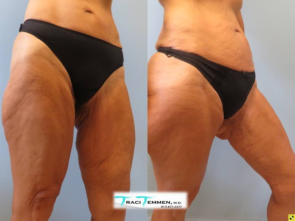 Thigh Lift Before & After
