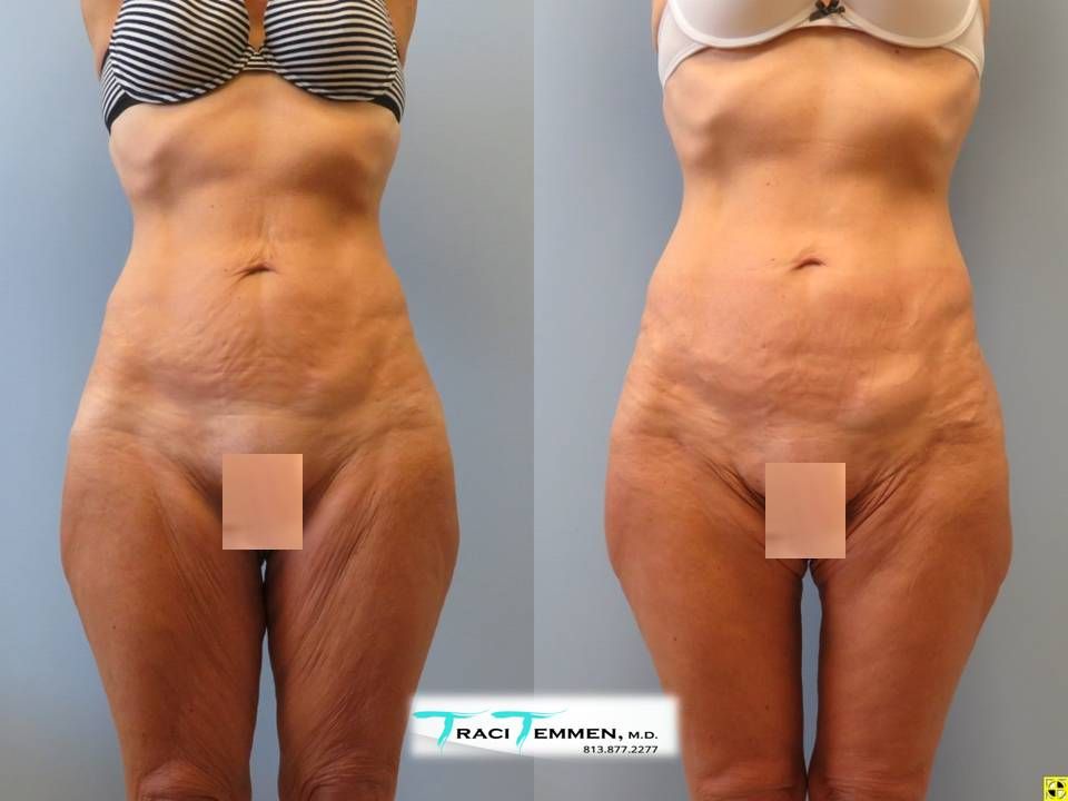 Thigh Lift Before & After