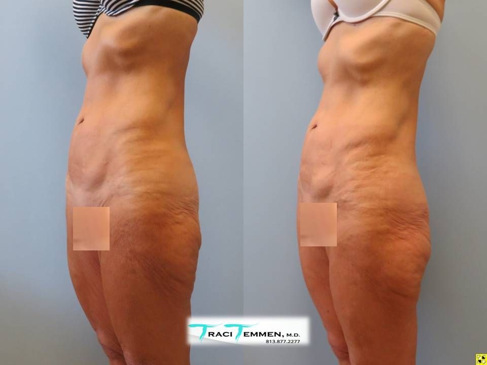 Thigh Lift Before & After