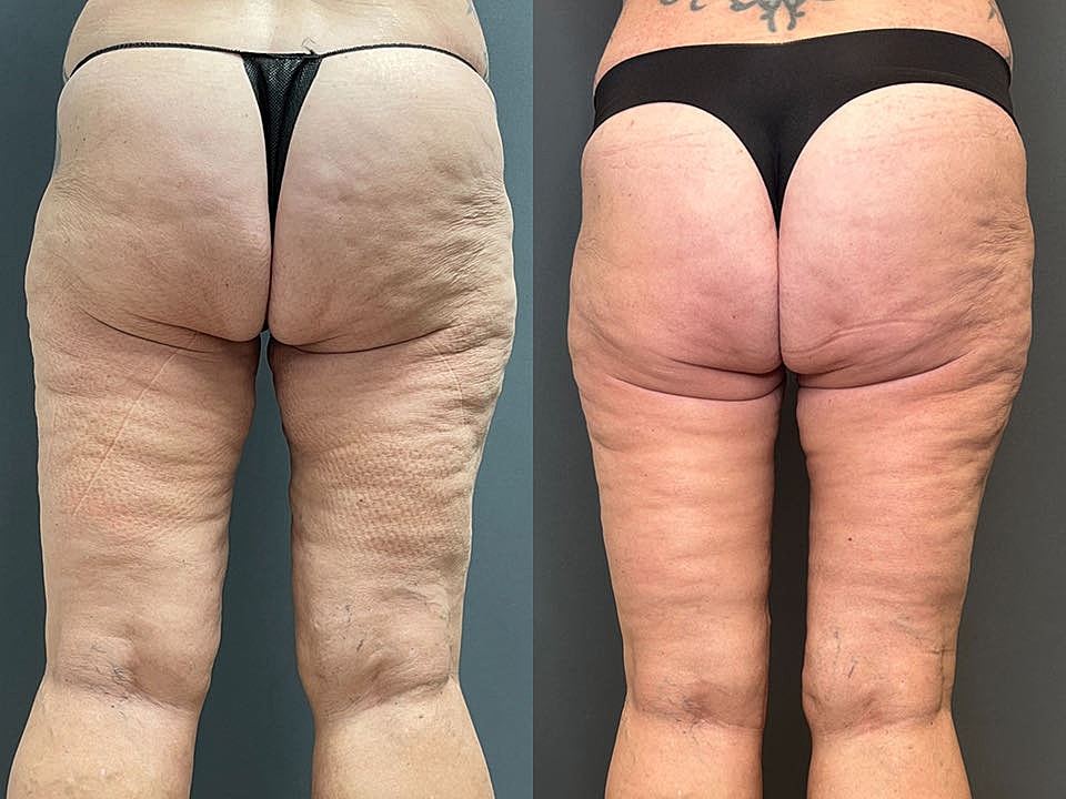 Thigh Lift Before & After