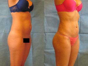 Lipoetching Before & After