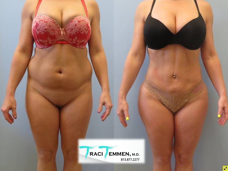 Lipoetching Before & After