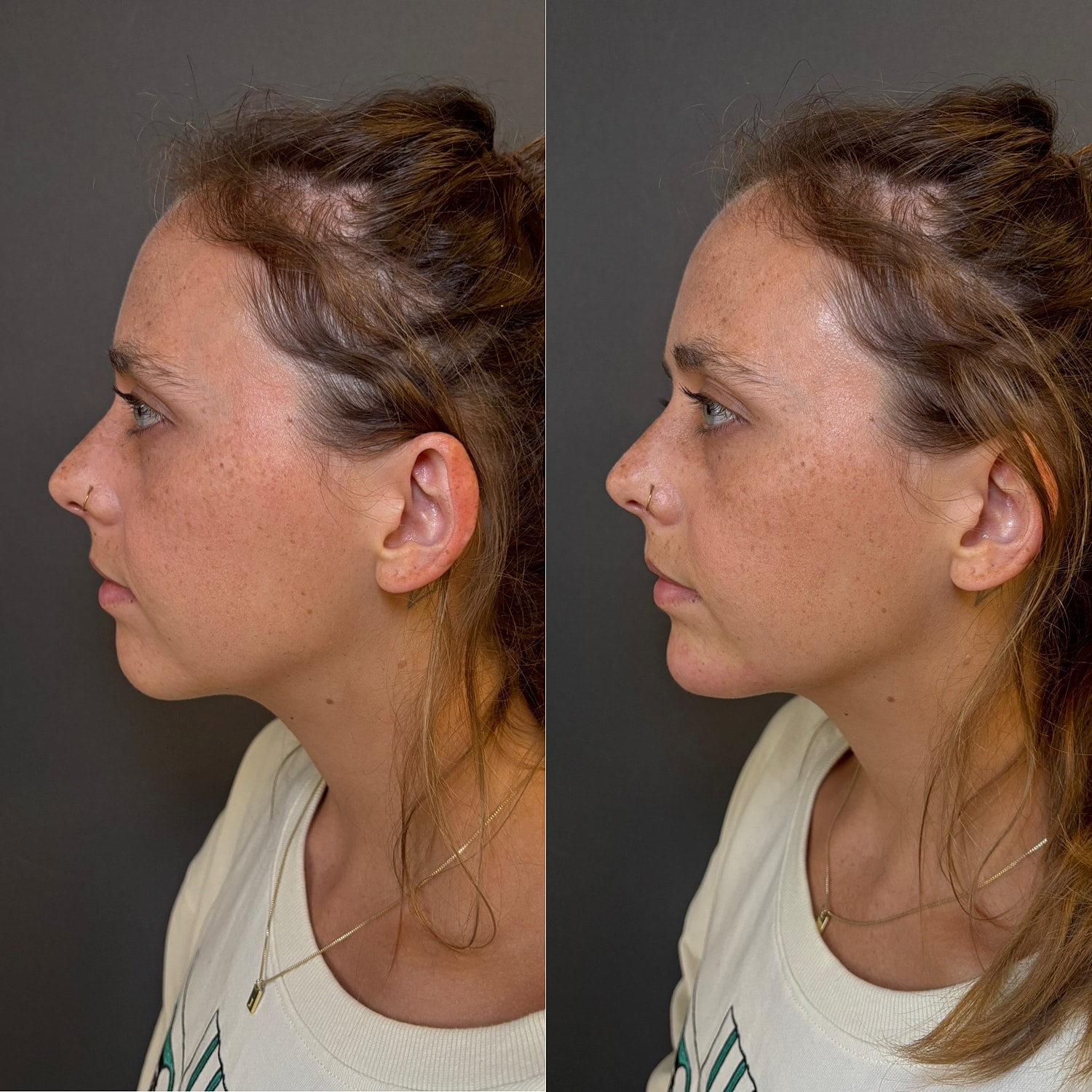 Chin Filler Before & After