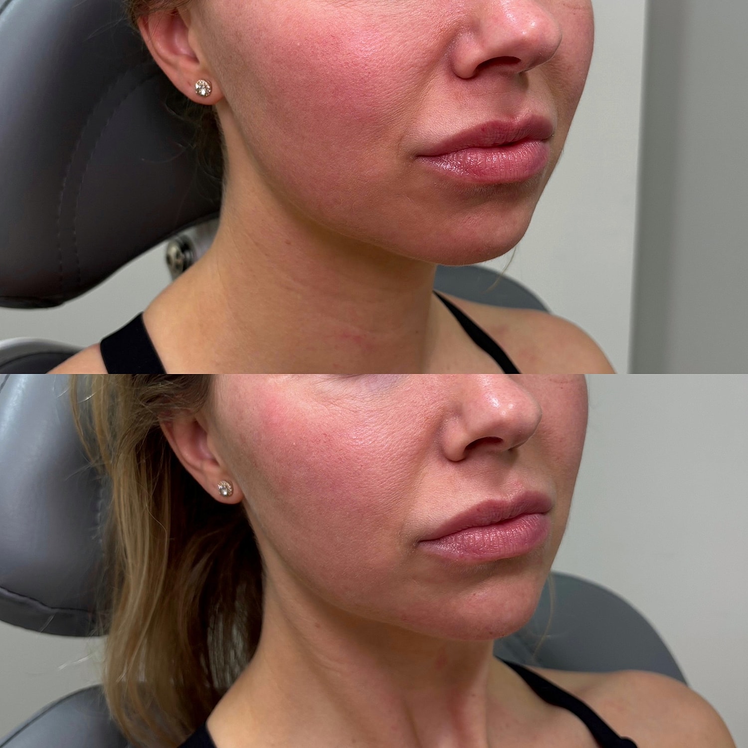 Chin Filler Before & After