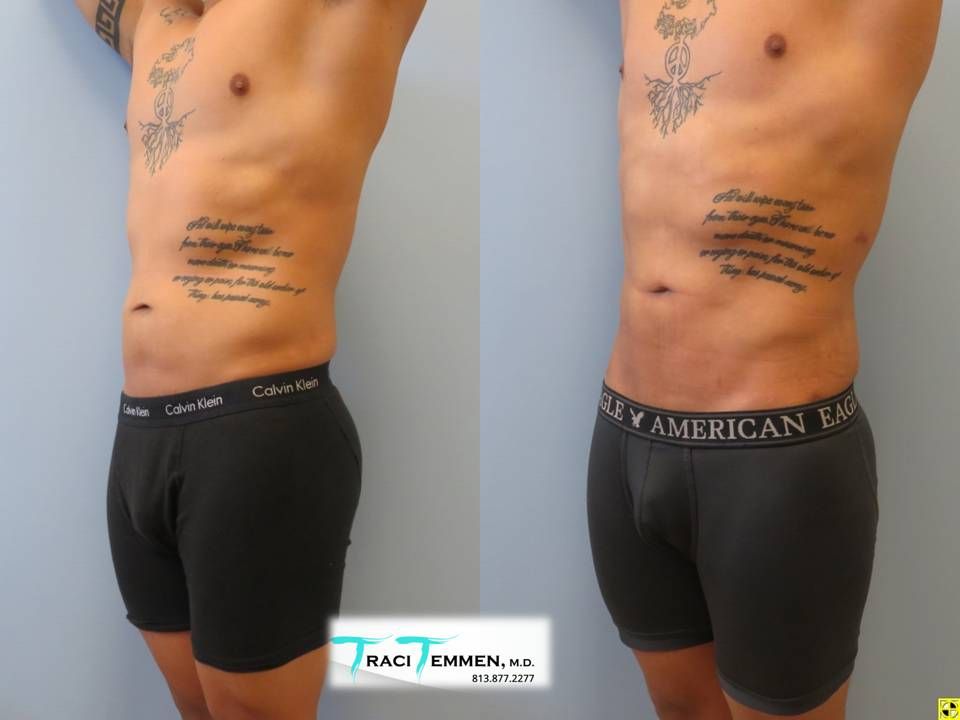 Male Lipoetching Before & After