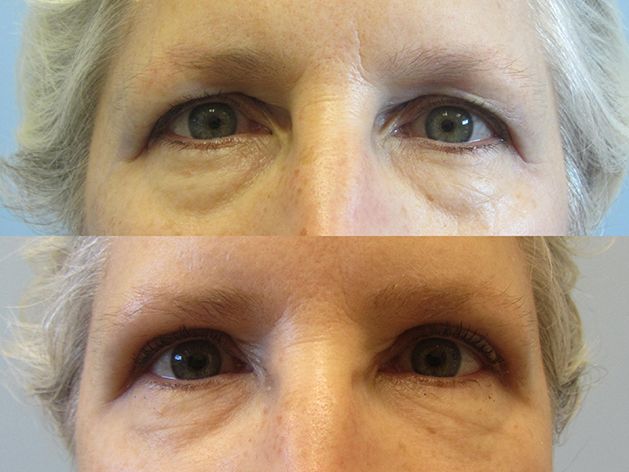 Eyelid Surgery Before & After