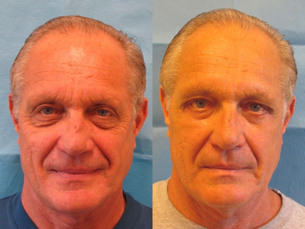 Eyelid Surgery Before & After